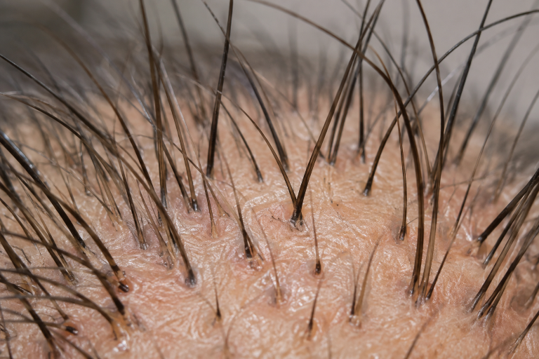 5 Businesses That Support A Complete Hair Restoration Plan In Washington, DC